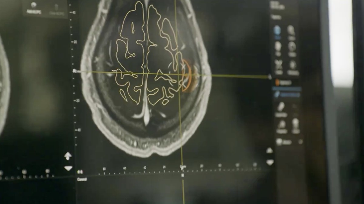 Foto: Neuralink buka-bukaan masalah pada proyek implan chip otak ke manusia. Startup milik Elon Musk tersebut mengaku ada kabel kecil yang salah posisi di dalam otak pasien pertamanya. (X @Neuralink)