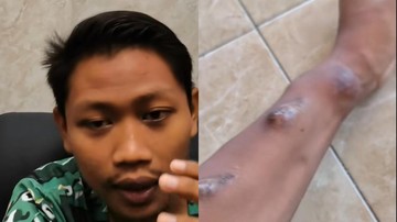 Pria Tuban mengidap gagal ginjal stadium 5. (Foto: IG @edipaeji dengan izin yang bersangkutan)
