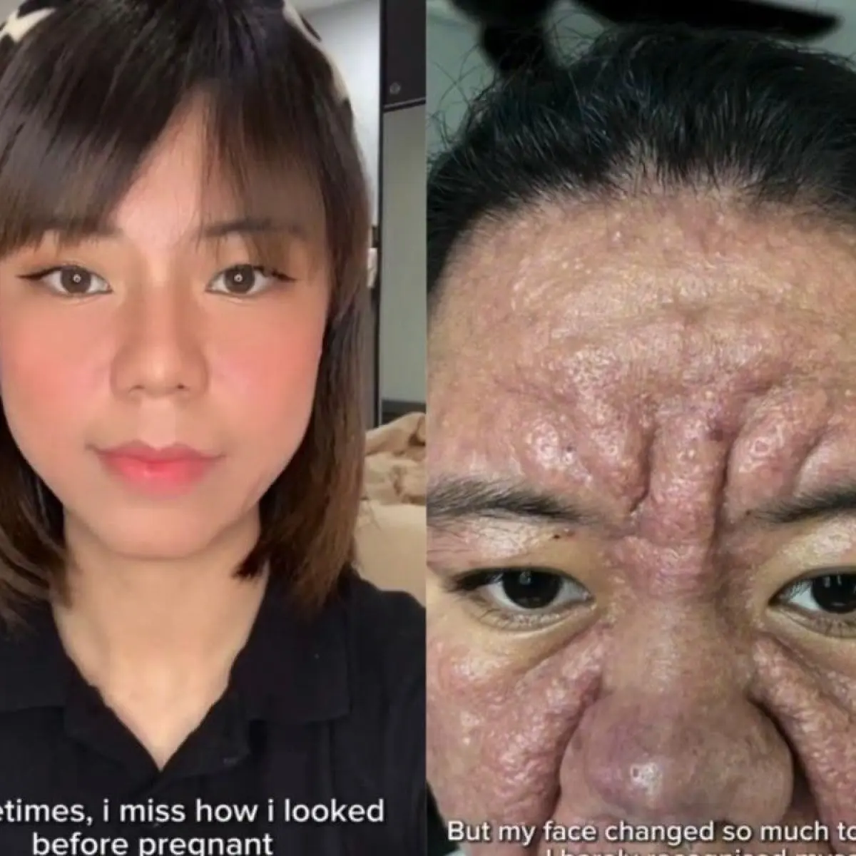 Kisah haru perjuangan wanita ini pulihkan kulit wajahnya yang berubah akibat hormon kehamilan. Foto: Dok. Instagram @farahf4izal.