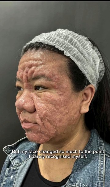Kisah haru perjuangan wanita ini pulihkan kulit wajahnya yang berubah akibat hormon kehamilan. Foto: Dok. Instagram @farahf4izal.
