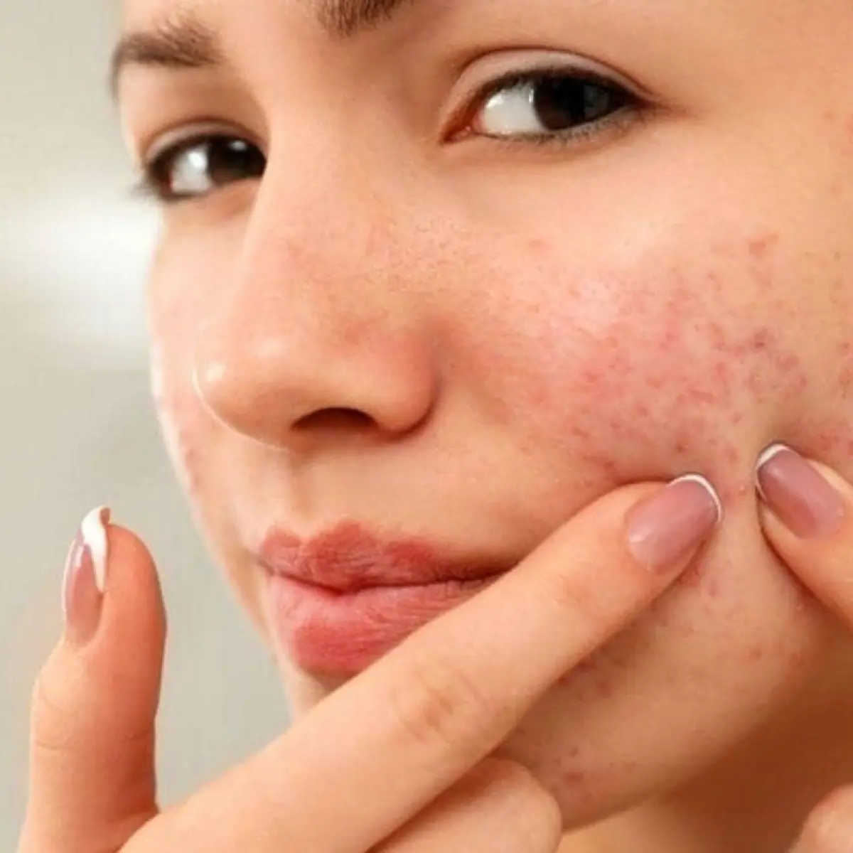 Mengurai Tujuh Pemicu Utama Kulit Wajah Kemerahan di Area Hidung dan Solusi Penanganannya