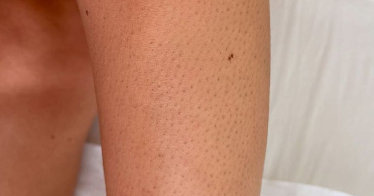 5 Tips Ampuh Atasi Strawberry Skin Menurut Pakar