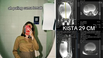 Perut Membesar Tak Wajar, Wanita Bekasi Ini Ternyata Simpan Kista Ovarium Raksasa 29 Cm