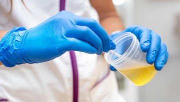 Kenali Sinyal Bahaya Fungsi Ginjal dari Perubahan Warna Urine Anda