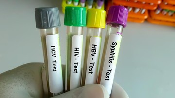 Lonjakan IMS di Kalangan Gen Z dan Ancaman Bakteri Kebal Obat: Sorotan Kemenkes dan Pakar Kesehatan